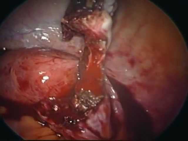 эндометриоз киста Аболмасов А.В.wmv смотреть онлайн