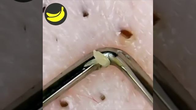 Выдавливание акне косметологической петлей
