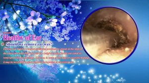 Cholesteatoma/Холестеатома #28