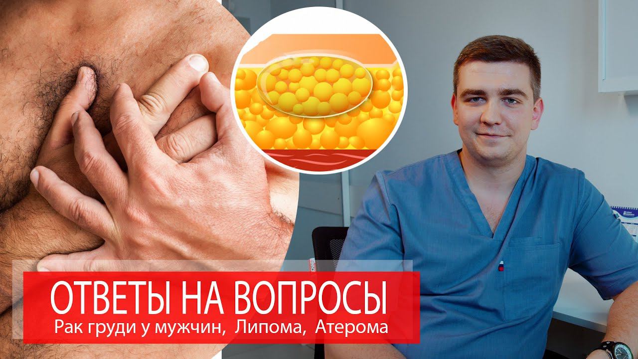 Рак груди у мужчин, Липома, Атерома, Жировик | ОТВЕТЫ НА ВОПРОСЫ смотреть онлайн