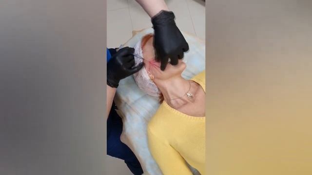 Проведение коррекции средней трети лица филлером на основе гиалуроновой кислоты Стилаж XL. #Shorts смотреть онлайн