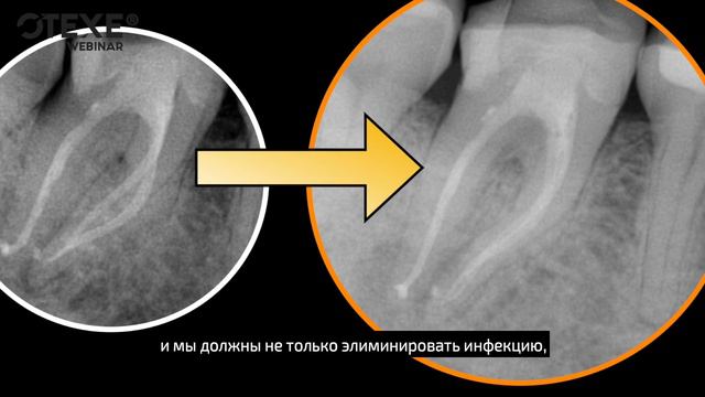 3 ВЕБИНАРА | АЛГОРИТМИЧЕСКИЙ ПОДХОД К КЛИНИЧЕСКОЙ ЭНДОДОНТИИ смотреть онлайн