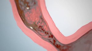 Что такое гастроэзофагеальная рефлюксная болезнь (ГЭРБ)?