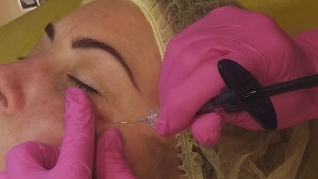 Периорбитальная зона. Канюля(фрагмент) смотреть онлайн