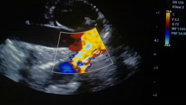 Врожденный порок - ОАП - Открытый артериальный проток у 3х-месячного котенка! смотреть онлайн