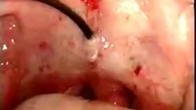 Лечение храпа плазмой.mp4 смотреть онлайн