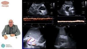 Ультразвуковая диагностика портальной гипертензии у детей