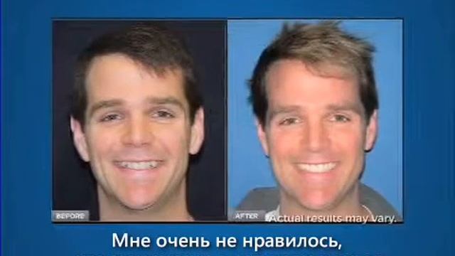 Система коррекции прикуса при помощи съемных прозрачных капп ИНВИЗИЛАЙН Invisalign смотреть онлайн