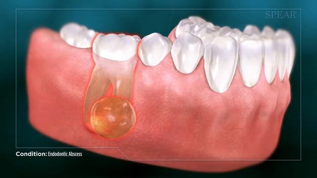 Dental Abcess - Why Root Canal Treatment Is Needed смотреть онлайн