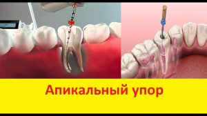 Эндодонтия для начинающих - техника степ бэк, формирование апикального упора - лечение каналов
