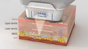 SMAS lifting Ultraformer 3. СМАС лифтинг и комплексное моделирование лица