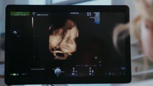 ЧТО ВЫТВОРЯЕТ МАЛЫШ В ЖИВОТЕ ВО ВРЕМЯ УЗИ | 5 интересных вещей которые делает малыш во время УЗИ