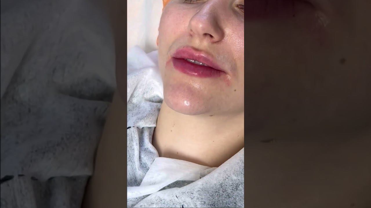 Коррекция губ. #врачкосметолог #эффективнаякосметология
