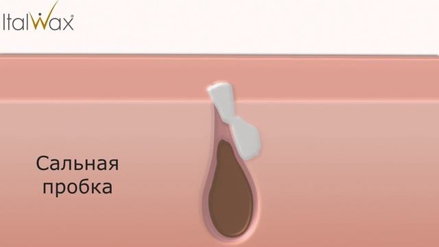 Вросшие волосы Что же делать? смотреть онлайн