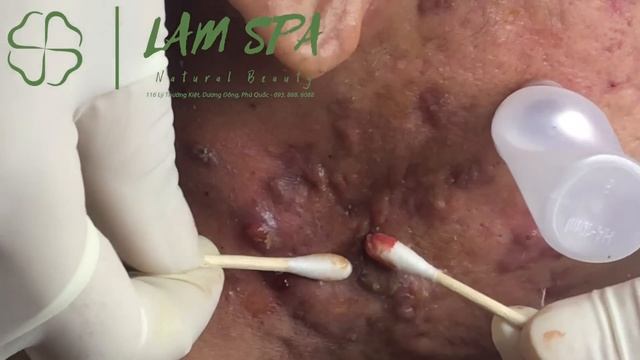 Treatment of acne pustules, severe inflammation | Mr.L Part2 | Điều trị mụn mủ viêm nặng | LAMSPA смотреть онлайн