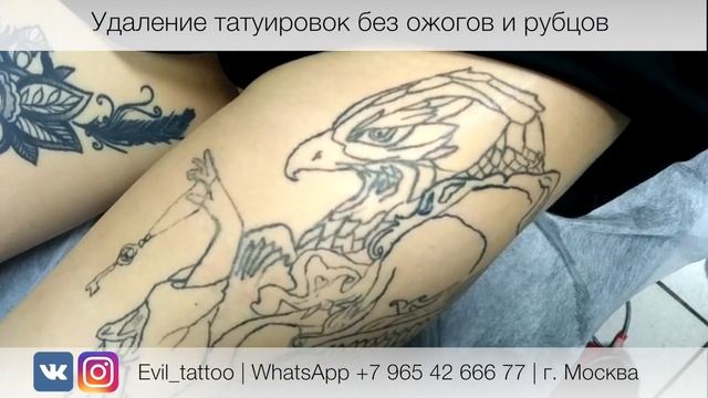 Лазерное удаление без травм, ожогов и рубцов. смотреть онлайн