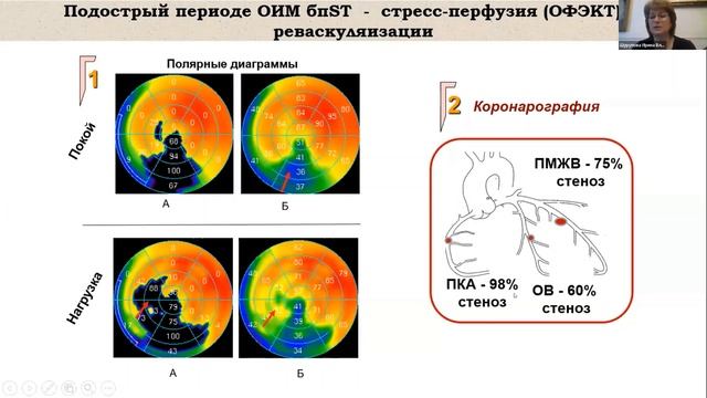 Шурупова И.В. (Россия) Нужны ли кардиологу методы радионуклидной диагностики при ОКС