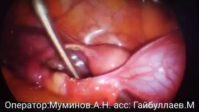 Киста левая маточная труба. смотреть онлайн