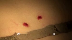 Удаление родинок  невусов