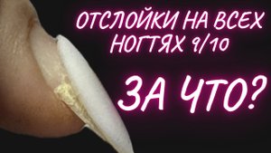 Отслойки на всех ногтях, почему ногти отслаиваются ?