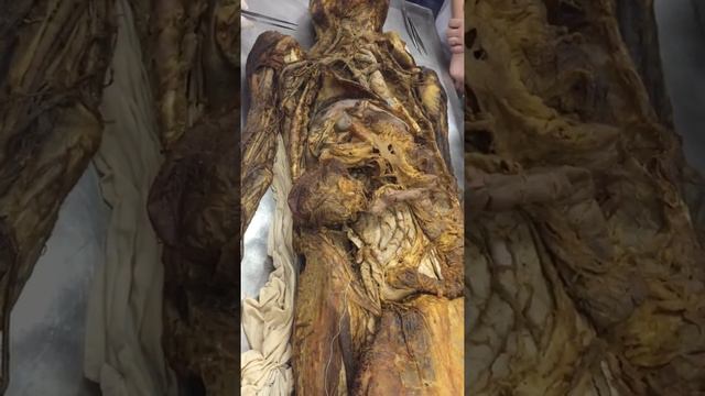 Подвздошная артерия. Артерии. Анатомия смотреть онлайн