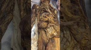 Подвздошная артерия. Артерии. Анатомия