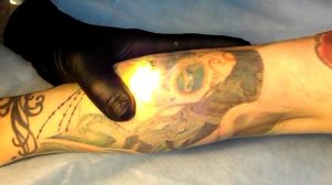 Выведение татуировок лазером