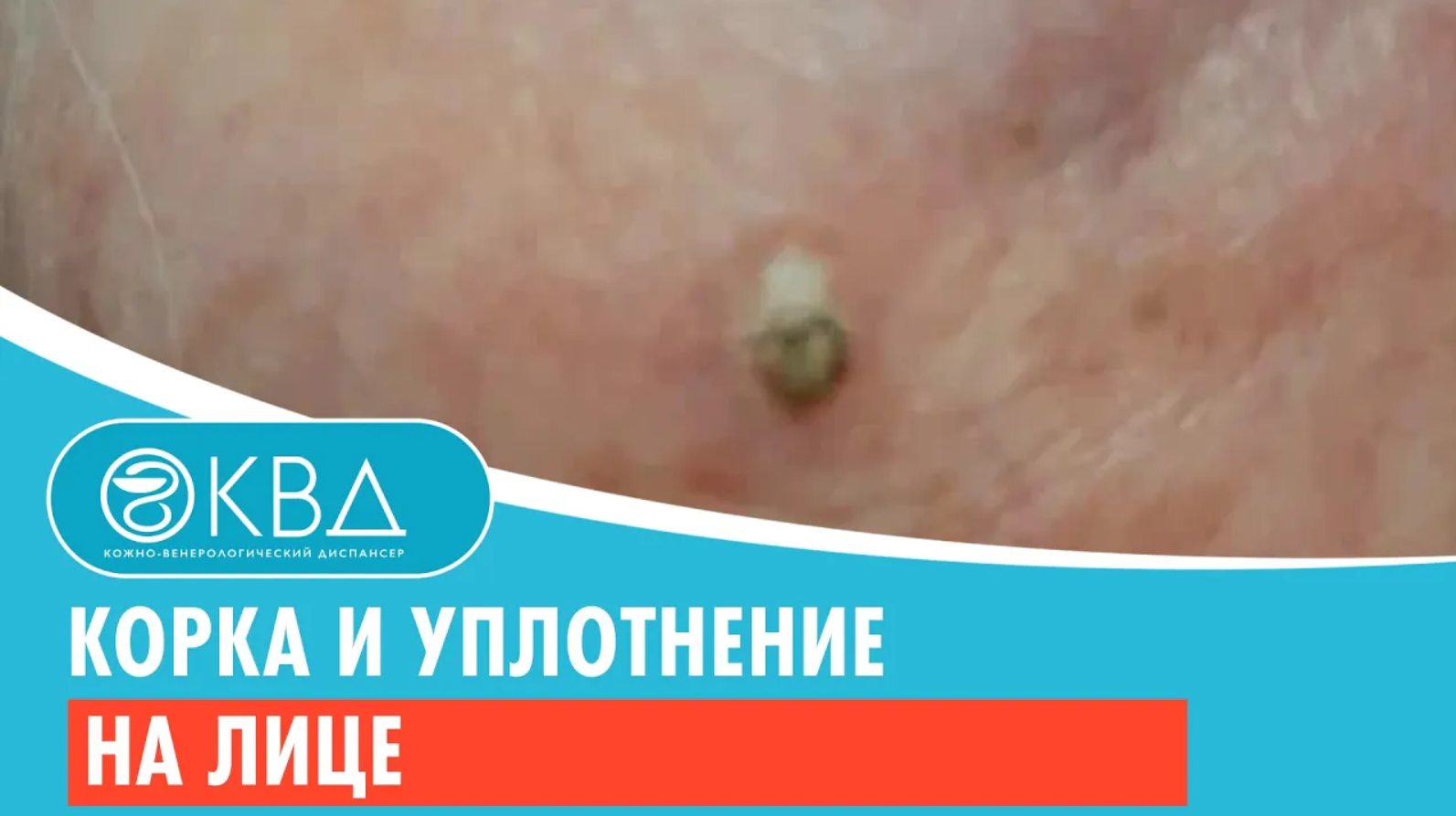 ➡ Корка и уплотнение на лице. Клинический случай №837