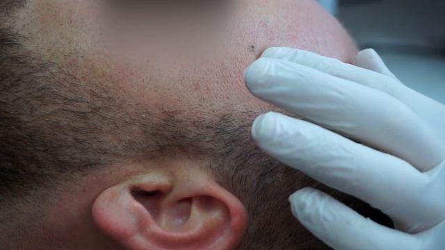 Удаление Ангиомы Диодным Лазером (Лоб) смотреть онлайн