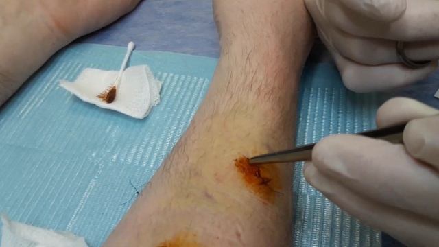 Снятие швов после удаления множественных липом при липоматозе смотреть онлайн