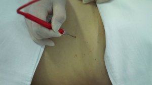 Удаление гемангиомы, папиломы