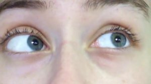 Видео 1   Появление нистагма при определенных направлениях взора