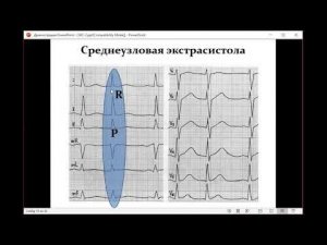 ЭКГ - электрокардиограмма (формат ответа и разбор примеров). (ДЛЯ СТУДЕНТОВ)