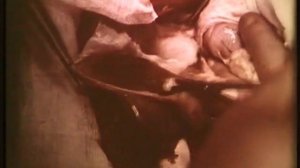 Методика холецистэктомии © Methods of cholecystectomy