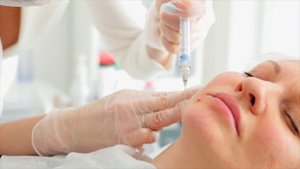 Векторный лифтинг Radiesse