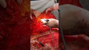 Азизов Абдулла Алискендарович. Пластический хируг. Бариатрия