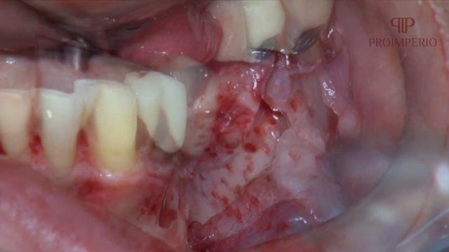 Bone Ring Posterior com Dr Marcelo Nunes - Proimperio смотреть онлайн