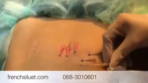 Коррекция зоны живота нитями - Dr.Suleymanova