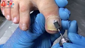 Онихолизис ногтей на ногах / Кератоз ногтей