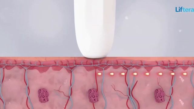 HIFU SMAS лифтинг теперь в Евро-Шарм! смотреть онлайн