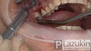 Открытый синус-лифтинг после перфорации