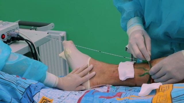 Эндовенозная лазерная коагуляция