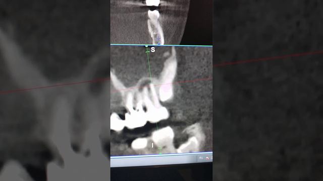 Диагностика апекального периодонтита 27. Клиническая рентгенология.