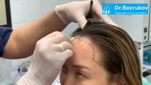 Пересадка волос у женщин в клинике доктора Безрукова