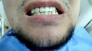 СРОЧНО ТИШ КУЙИШ МИКРОПРОТЕЗ !