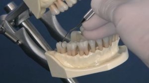 Зондирование зубов в стоматологии