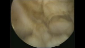 Интерстициальная миома матки. Interstitial fibroids