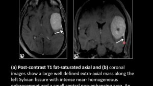 Atypical Meningioma