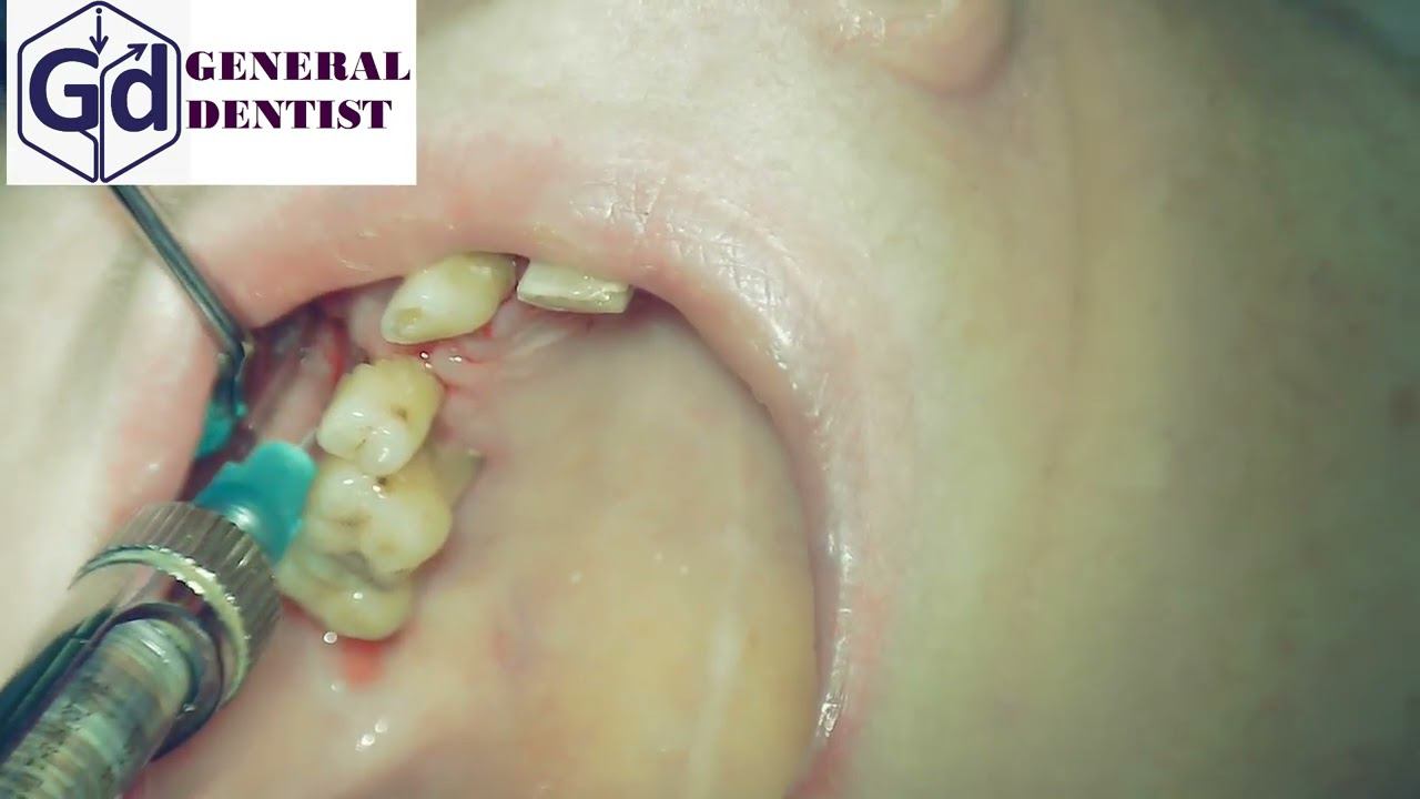 Infiltration anesthesia for extraction 15,16 teeth.