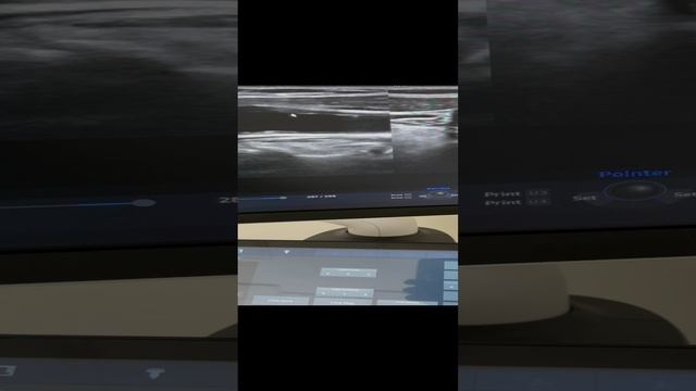 Исследование сонных артерий на предмет риска инсульта. Часть 1. Сосудистый хирург. Флеболог Москва